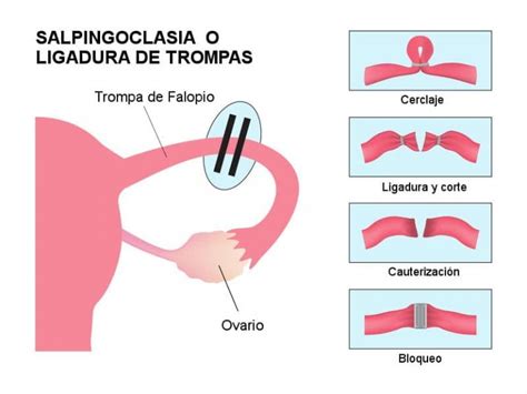 Cuál es la diferencia entre ligadura y corte de trompas Aquí una guía